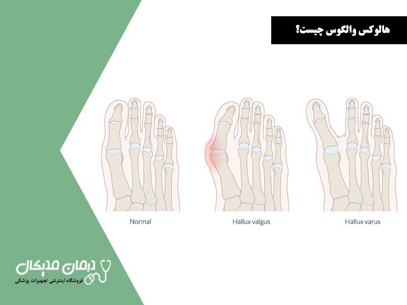 هالوکس-والگوس-چیست؟